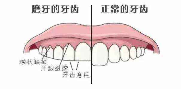 牙齿严重磨损 由于磨牙一般都是发生在后牙区,而后牙大多是磨牙,因此